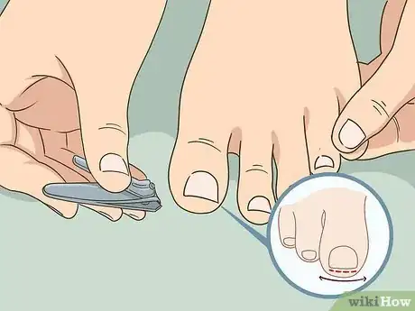 Imagen titulada Soak an Ingrown Toenail Step 7