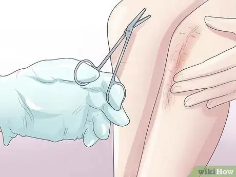 Imagen titulada Know if You Have a Baker's Cyst Step 12