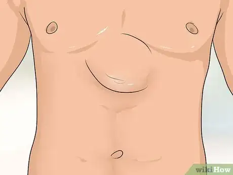 Imagen titulada Know if You Have a Hernia Step 17