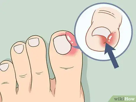 Imagen titulada Soak an Ingrown Toenail Step 9