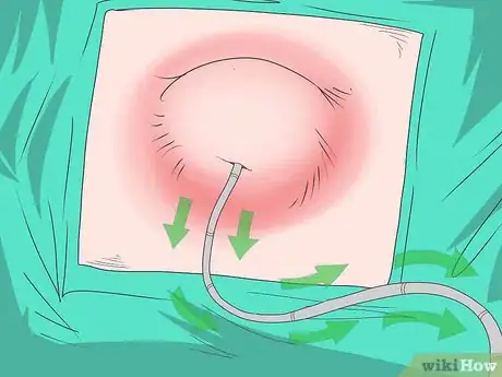 Imagen titulada Drain a Cyst Step 3
