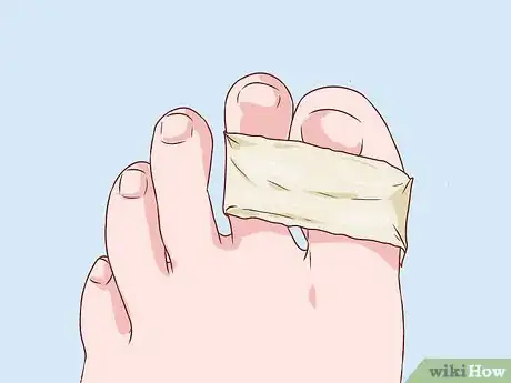 Imagen titulada Bandage Fingers or Toes Step 8