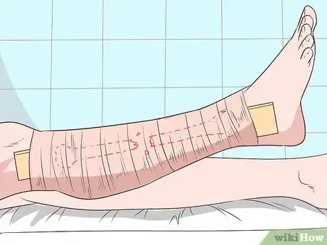 Imagen titulada Apply a Skin Traction Step 5