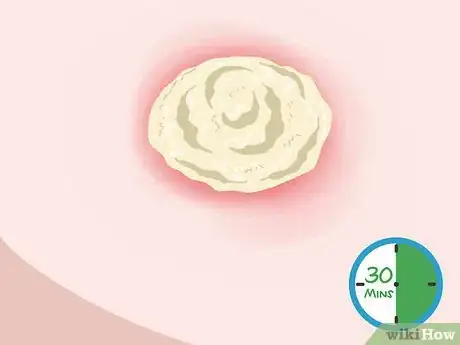 Imagen titulada Get a Boil to Come to a Head Step 3