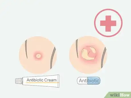 Imagen titulada Get Rid of Ingrown Pubic Hair Step 16