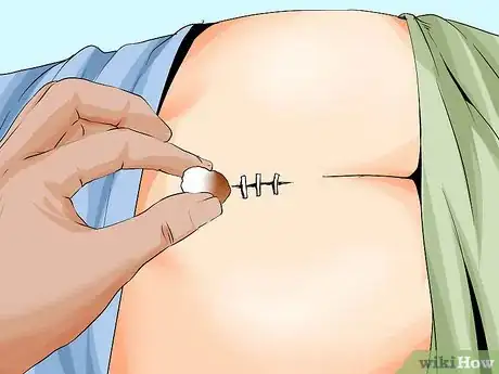Imagen titulada Treat a Pilonidal Cyst Step 3