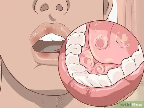 Imagen titulada Relieve Gum Pain Step 6
