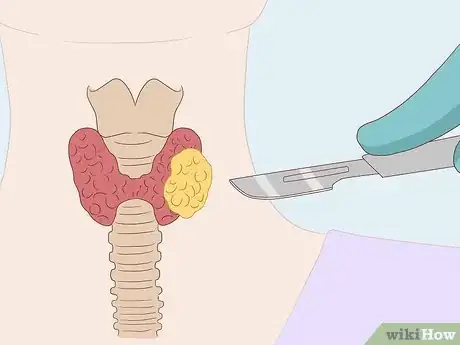 Imagen titulada Dissolve Nodules Naturally Step 10