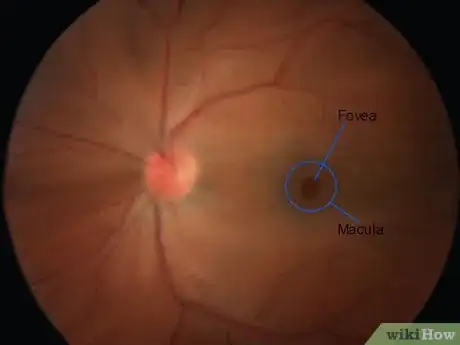 Imagen titulada Use an Ophthalmoscope Step 15