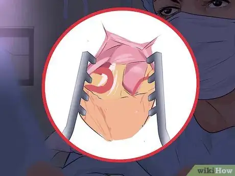 Imagen titulada Alleviate Pain Caused by Trigeminal Neuralgia Step 13