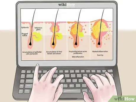 Imagen titulada Treat an Infected Sebaceous Cyst Step 16