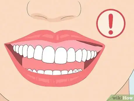 Imagen titulada Heal a Bitten Tongue Step 19