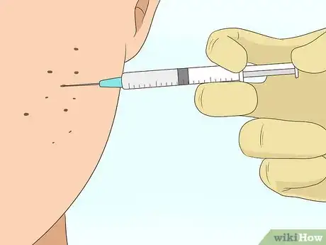Imagen titulada Get Rid of Acne Scars Fast Step 4