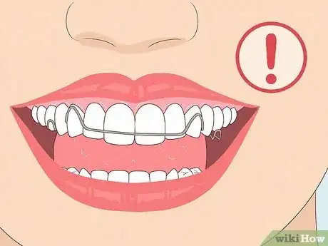 Imagen titulada Heal a Bitten Tongue Step 20