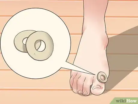 Imagen titulada Get Rid of Corns Step 3