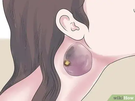 Imagen titulada Treat an Infected Sebaceous Cyst Step 18