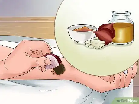 Imagen titulada Treat Dry Gangrene Step 9