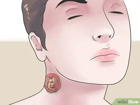 Imagen titulada Treat an Infected Sebaceous Cyst Step 20