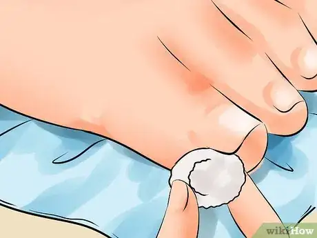 Imagen titulada Remove an Ingrown Toenail Step 6