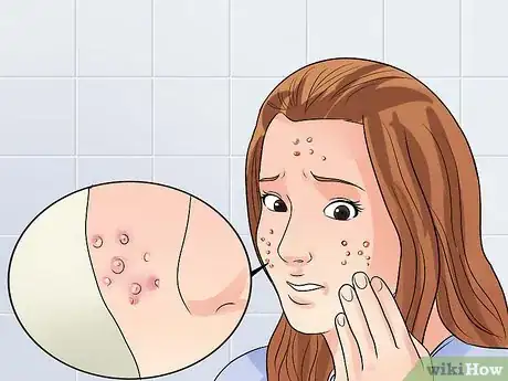 Imagen titulada Get Rid of Acne if You Have Fair Skin Step 1