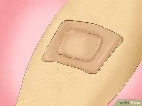 Imagen titulada Treat a Staph Infection Step 10