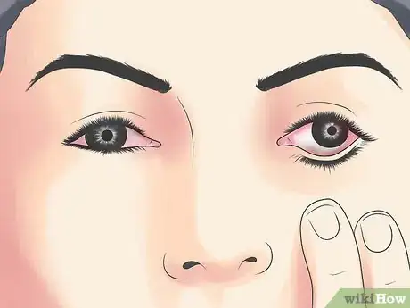 Imagen titulada Recover from Chikungunya Step 13