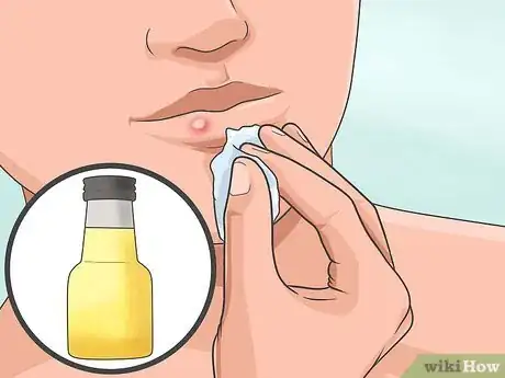 Imagen titulada Heal a Cold Sore Naturally Step 7