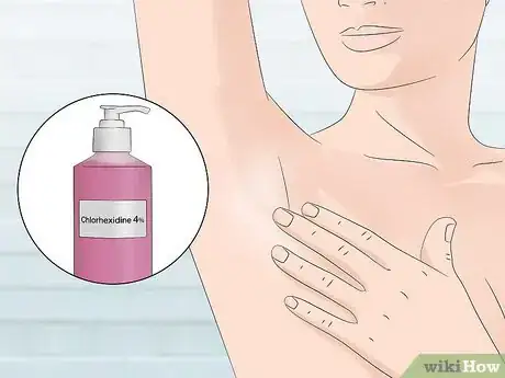 Imagen titulada Stop Armpit Pimples Step 2