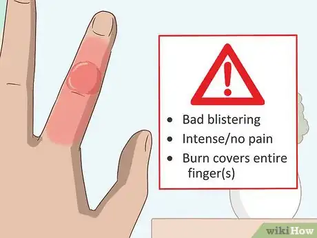 Imagen titulada Treat a Blistering Burn on Your Finger Step 4
