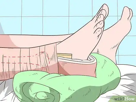 Imagen titulada Apply a Skin Traction Step 9