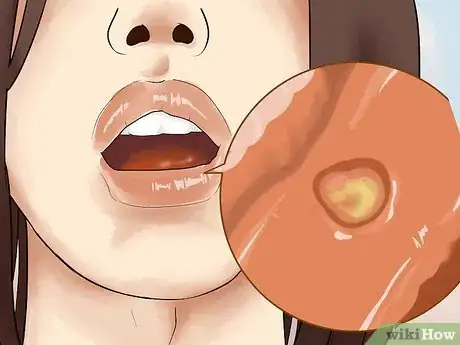 Imagen titulada Heal Mouth Inflammation Step 1