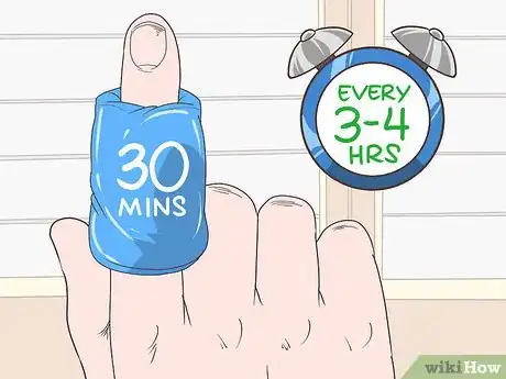 Imagen titulada Fix a Dislocated Finger Step 9