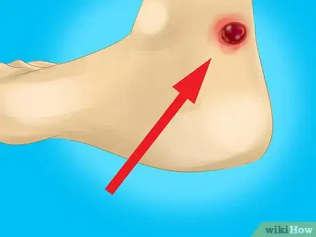 Imagen titulada Treat Raw Blisters on the Palm of Your Hand Step 1