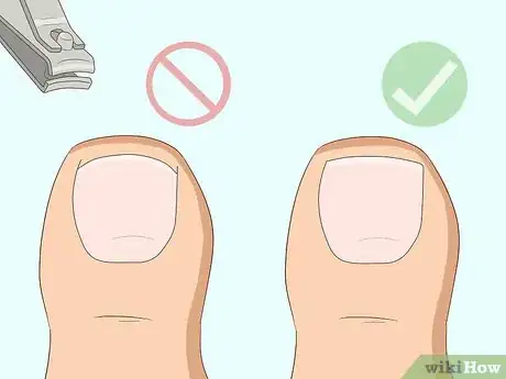 Imagen titulada Relieve Ingrown Toe Nail Pain Step 27
