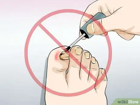 Imagen titulada Prevent the Spread of Fungal Infections Step 17