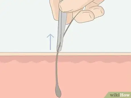 Imagen titulada Get Rid of Ingrown Pubic Hair Step 11