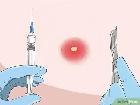 Imagen titulada Get a Boil to Come to a Head Step 16