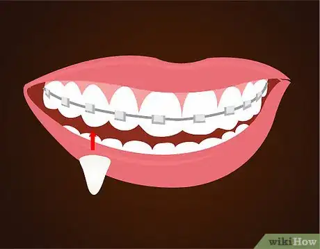 Imagen titulada Make Vampire Fangs if You Have Braces Step 4