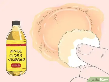 Imagen titulada Drain a Cyst Step 10