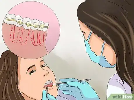 Imagen titulada Get Your Braces off Faster Step 3