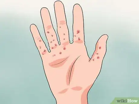 Imagen titulada Diagnose Scabies Step 4