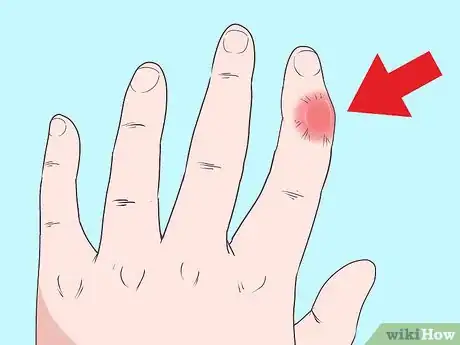 Imagen titulada Fix a Dislocated Finger Step 1