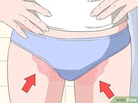 Imagen titulada Know if You Have Jock Itch Step 1