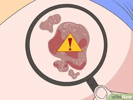 Imagen titulada Lighten Birthmarks Naturally Step 13
