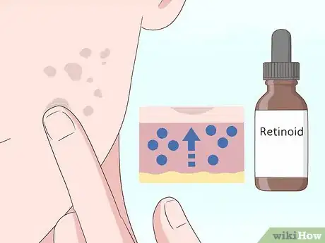Imagen titulada Get Rid of Acne Scars Fast Step 9