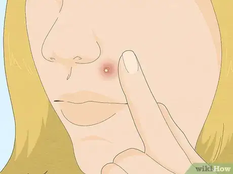 Imagen titulada Pop a Pimple Step 22