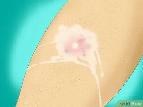 Imagen titulada Treat a Staph Infection Step 3