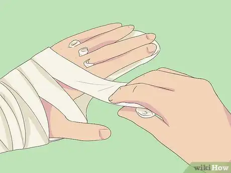 Imagen titulada Splint a Fractured Hand Step 8
