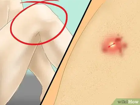Imagen titulada Treat a Staph Infection Step 8
