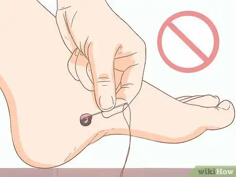 Imagen titulada Treat a Blood Blister Step 3